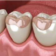 Close-up illustration of composite bonding material shaping the surface of a molar