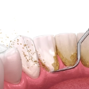Close-up of dental instruments used to examine and clean a tooth surface