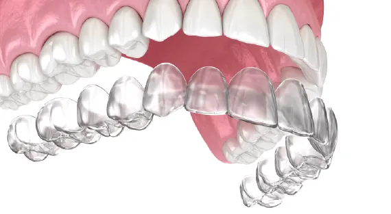 3D render of a clear dental aligner positioned over lower teeth