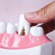Placing a replacement tooth onto a dental implant post