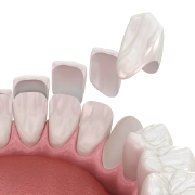3D illustration of a porcelain veneer being fitted to a tooth